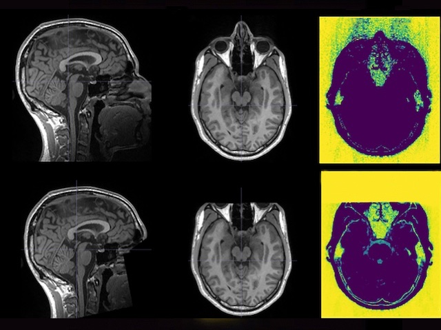 Ressonància magnètica cerebral